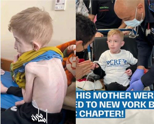 지난 3월 가자지구 병원에서 치료받던 파디(왼쪽 사진)와 5월 건강을 되찾은 모습(오른쪽 사진). [(왼쪽부터) 인스타그램 @translating_falasteen, @thepcrf 캡처]